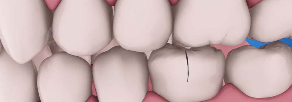 Tooth repair: how to fix a chipped, cracked or broken tooth 3