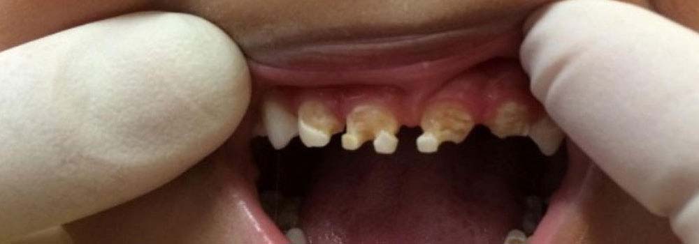 Tooth Decay: Signs, Symptoms & Treatments 29