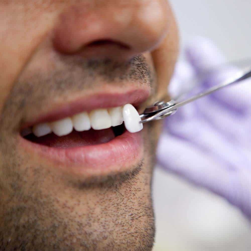 Dental Veneers: Costs, Types, Procedures & FAQ 2