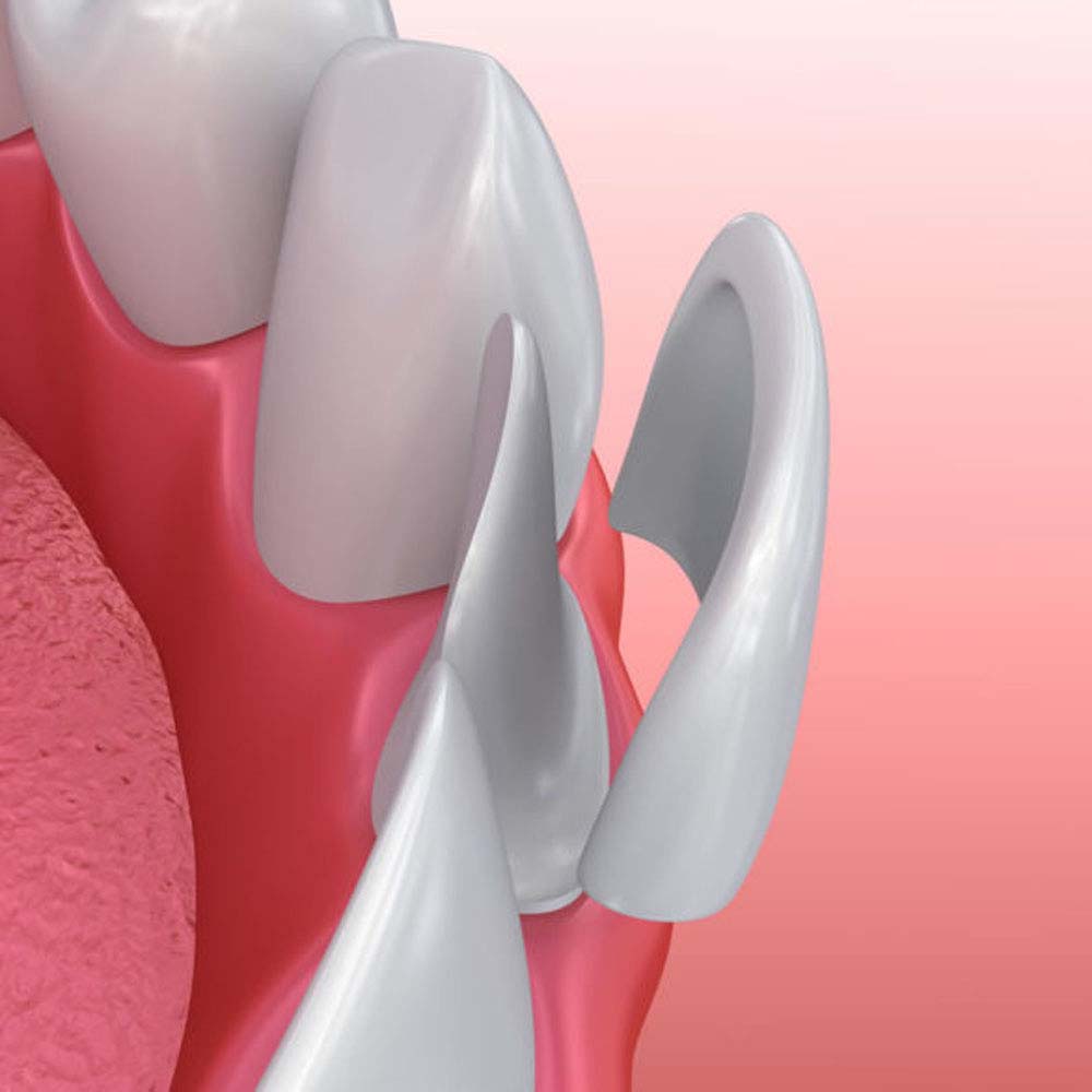 Dental Veneers: Costs, Types, Procedures & FAQ 1