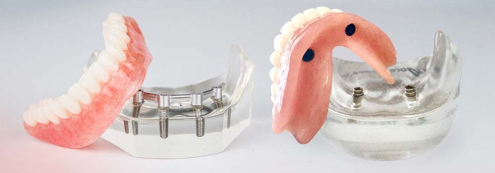 Denture Implants & Implant Retained Dentures: Procedure, Costs & FAQ 7