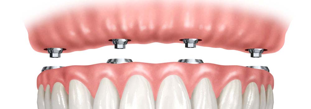 Denture Implants & Implant Retained Dentures: Procedure, Costs & FAQ 12