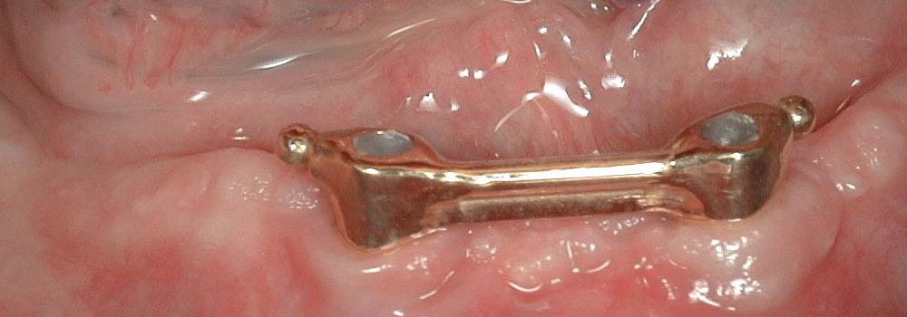 Denture Implants & Implant Retained Dentures: Procedure, Costs & FAQ 18