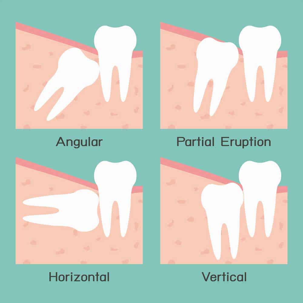 Wisdom Tooth Pain: Symptoms, Removal Procedure & FAQ 7