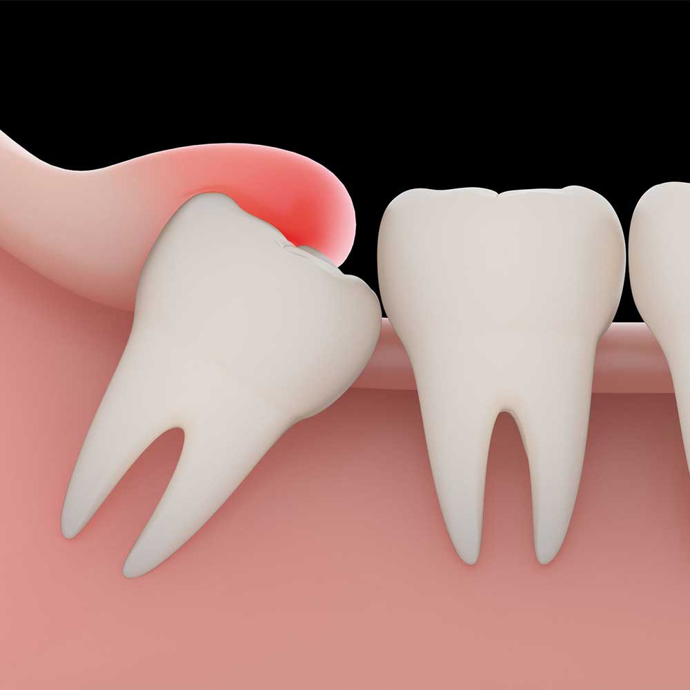 Wisdom Tooth Pain: Symptoms, Removal Procedure & FAQ 3