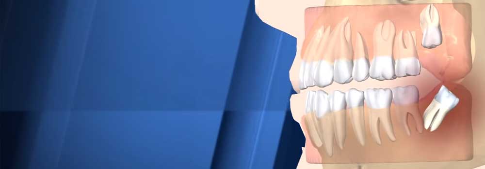 Wisdom Tooth Pain: Symptoms, Removal Procedure & FAQ 1