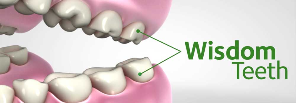 Wisdom Tooth Pain: Symptoms, Removal Procedure & FAQ 2