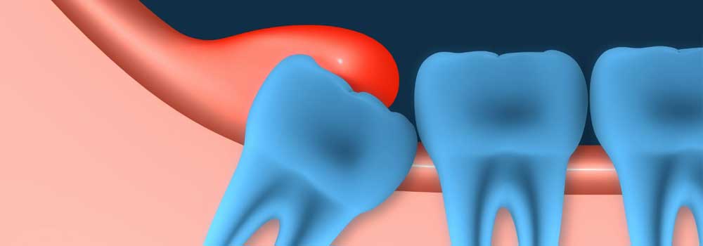Wisdom Tooth Pain: Symptoms, Removal Procedure & FAQ 23