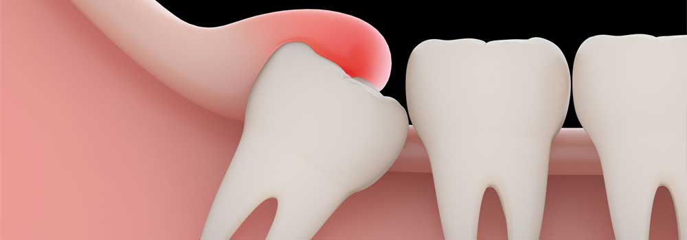 Wisdom Tooth Pain: Symptoms, Removal Procedure & FAQ 10