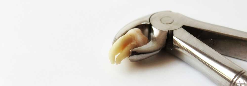Wisdom Tooth Pain: Symptoms, Removal Procedure & FAQ 16