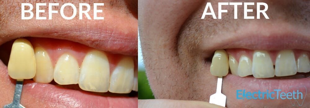 Tooth whitening before and after