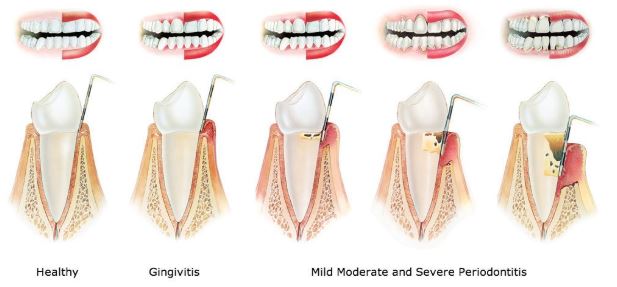 Gingivitis (Gum Disease): Symptoms, Causes, Treatments & FAQ 7
