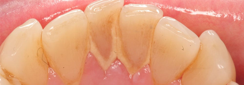 Lower teeth with staining
