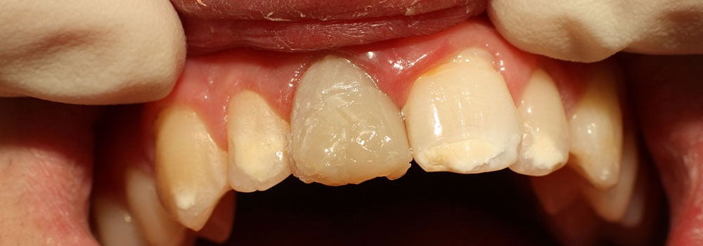 Photo showing badly damaged tooth