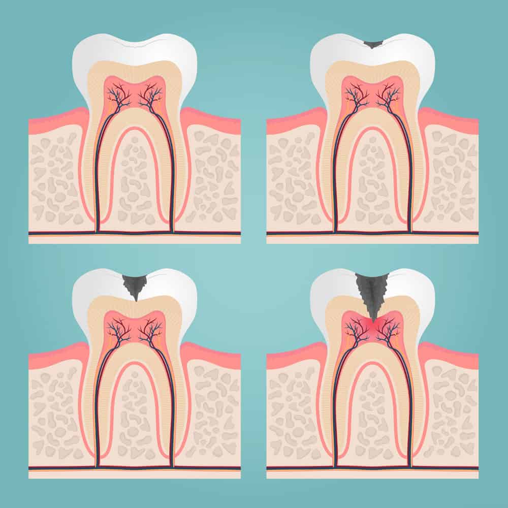 Stock Stages Tooth Decay
