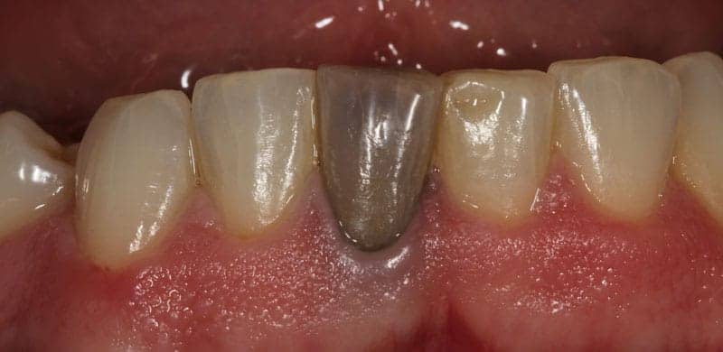 Dead Tooth Treatment Options | Dr. Jasmine Naderi