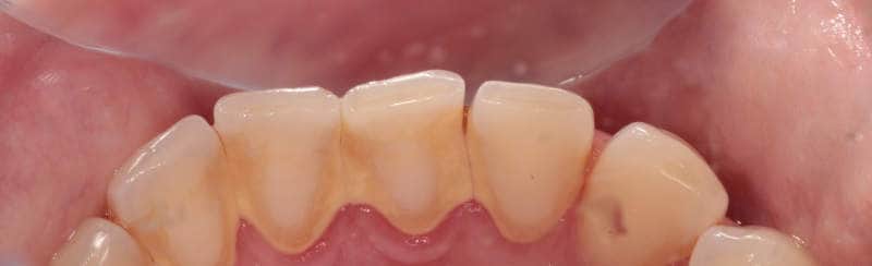 tartar build up on inside of teeth