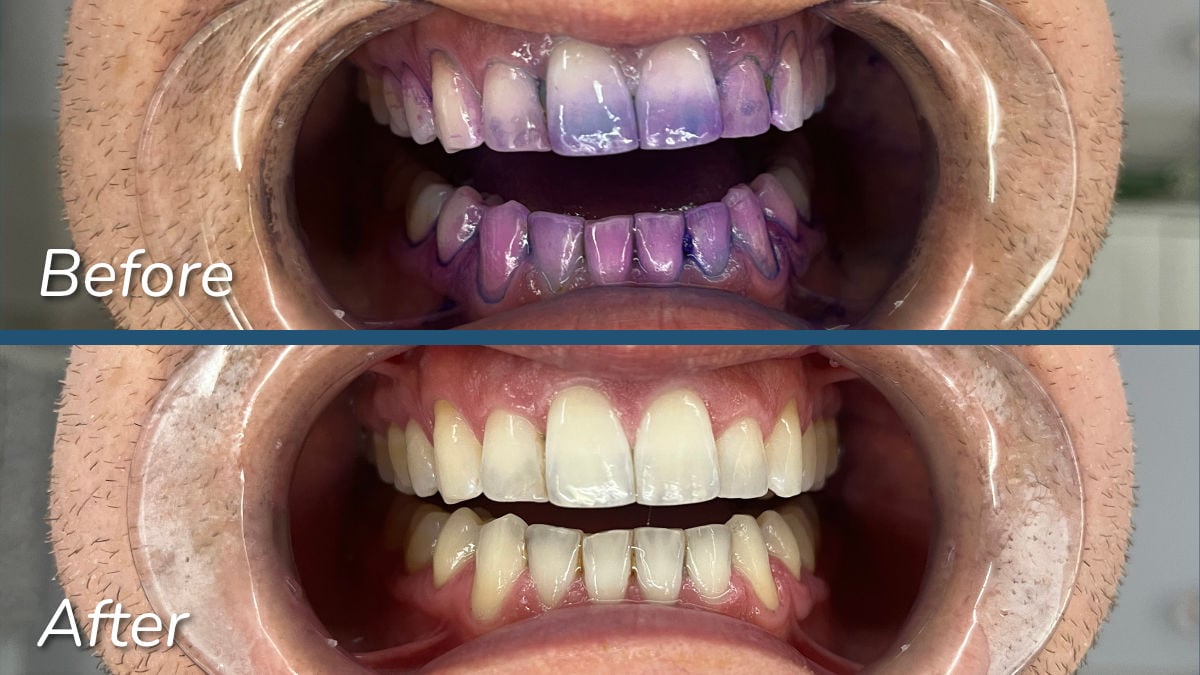 SURI 2.0 Plaque disclosing test before and after
